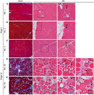 Physiological and Pathological Mitochondrial Clearance Is Related to Pectoralis Major Muscle Pathogenesis in Broilers With Wooden Breast Syndrome